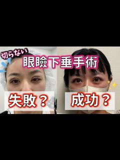 [x]切らない眼瞼下垂の手術【失敗？